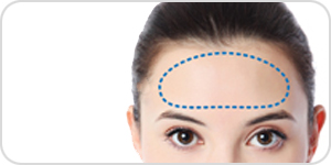 forehead implant